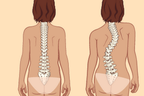 straight posture and scoliosis with chest osteochondrosis