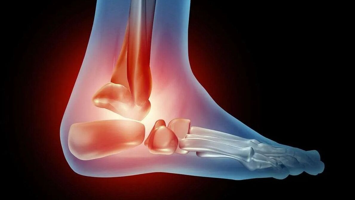 ankle arthrosis diagram