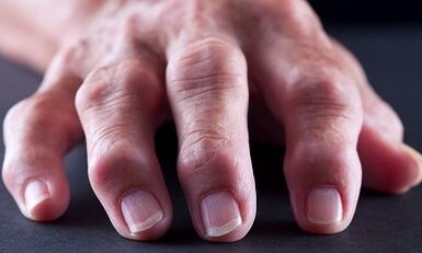 What is the difference between arthrosis between arthrosis