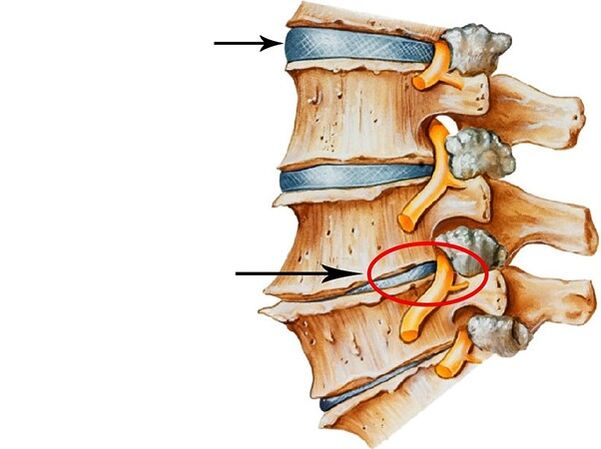 Disorders in intervertebral discs