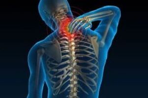 Cervical osteochondrosis leads to cervical pain
