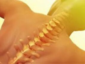 Osteochondrosis - spinal disease