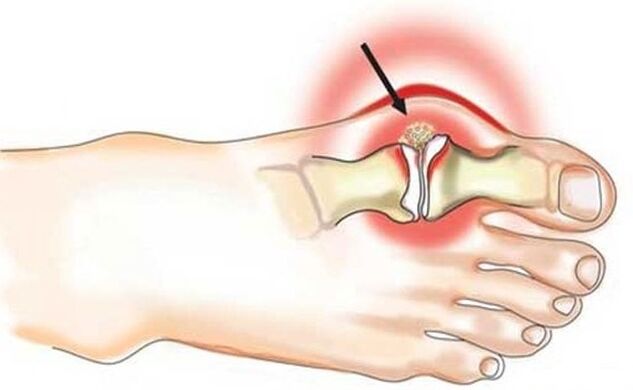 Inflammation of the joint of the big toe and foot due to arthritis