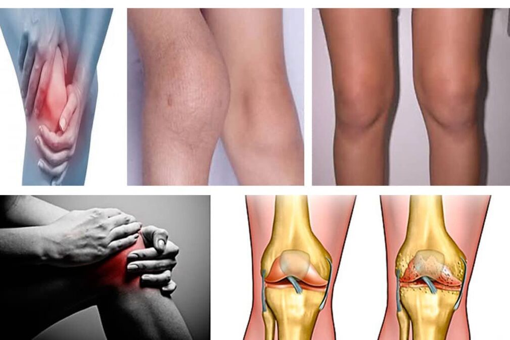 what is arthrosis