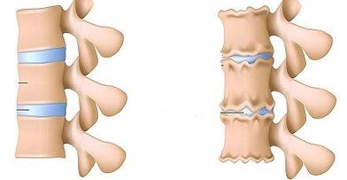 How to recognize the presence of lumbar osteochondrosis
