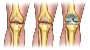 arthroplasty for knee arthrosis